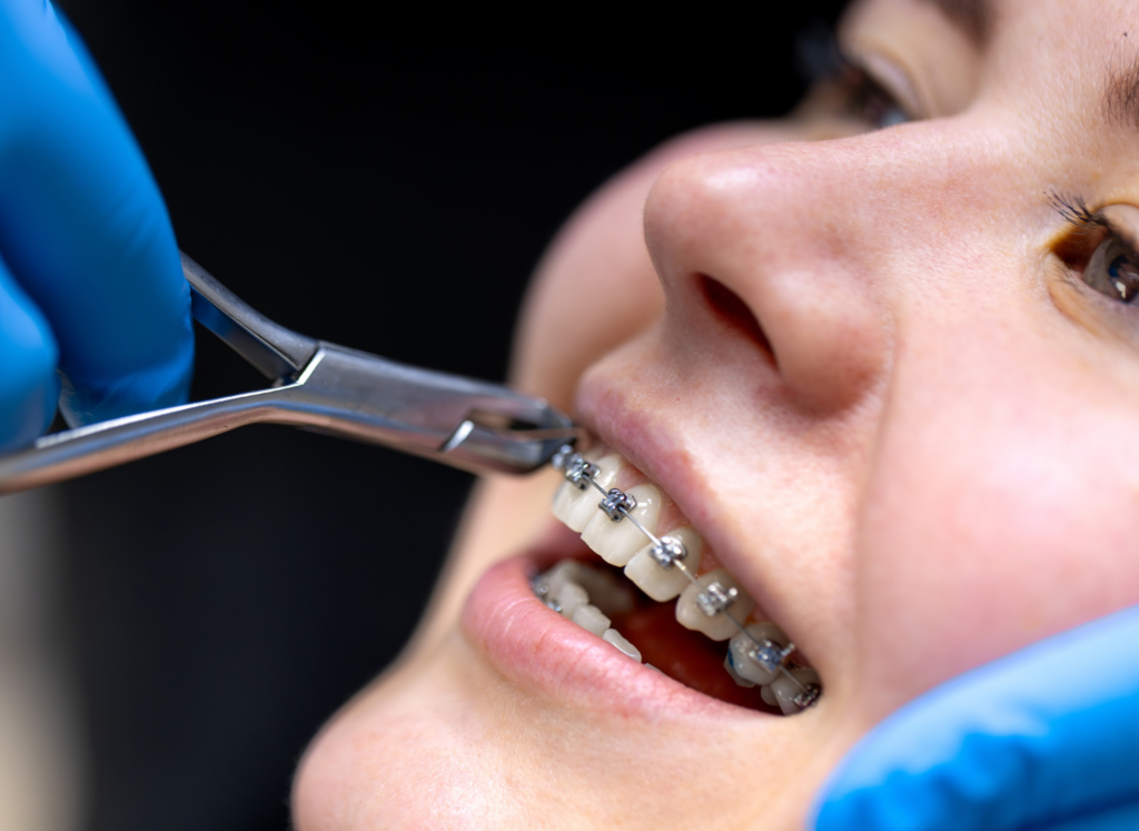 conventional braces - klinik pergigian sarah omar