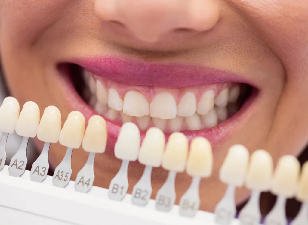 dental veneer - klinik pergigian sarah omar