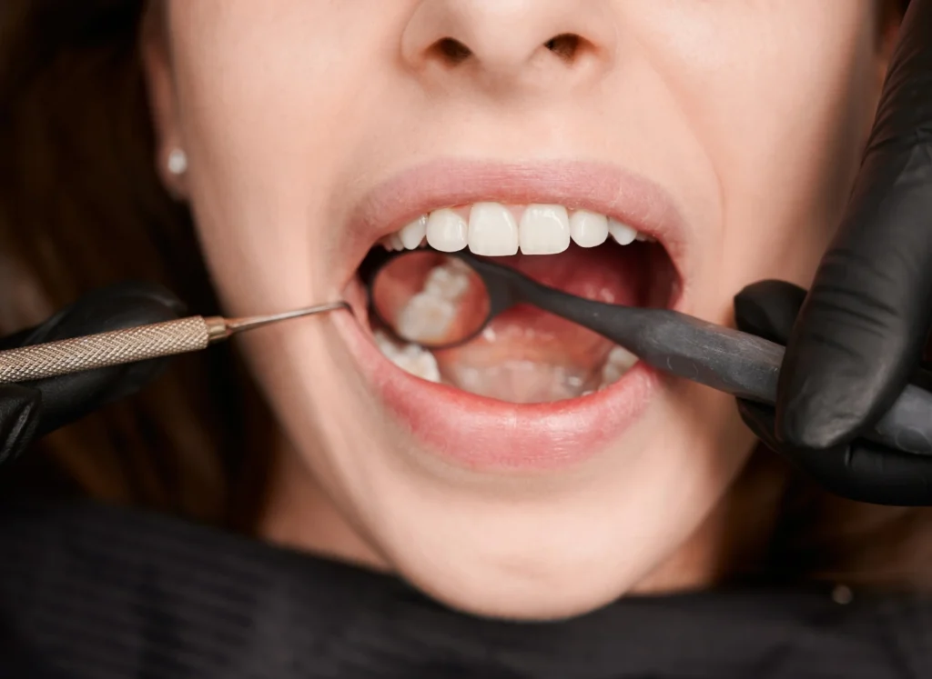 filling teeth - klinik pergigian sarah omar
