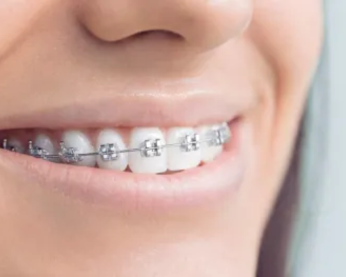 Braces - klinik pergigian sarah omar